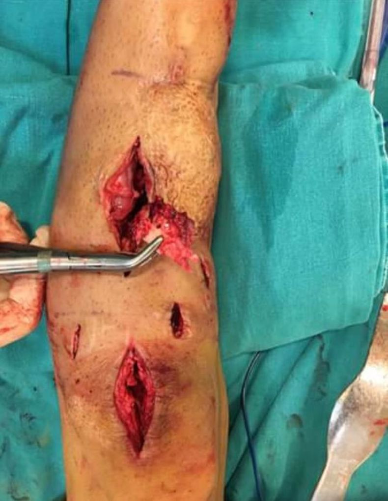 Страшно: Джино с тежка инфекция на крака от Биг Брадър! (оперираха го в Турция - снимките не са за хора със слаби сърца)