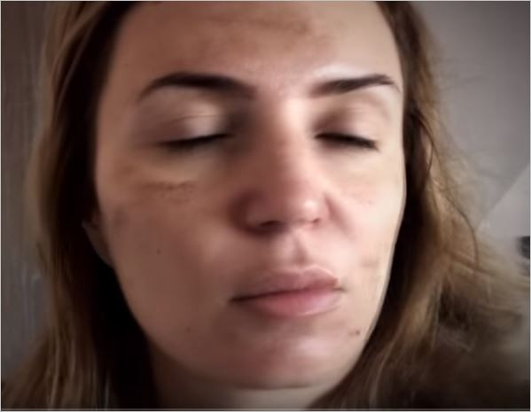Гледката е кошмарна - виж какво се случи с лицето на Ирина