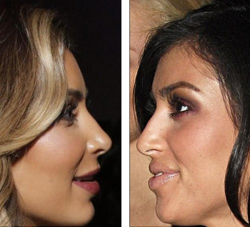 Ким отрича ринопластиката, но гърбицата на носа й я няма