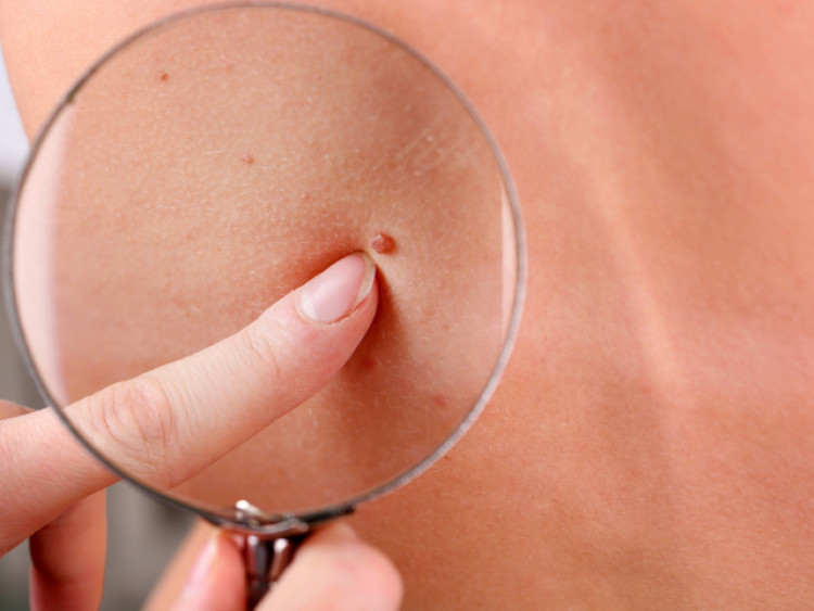 Не ги пренебрегвайте: 4 симптома, които издават ракa на кожата - Снимка 2