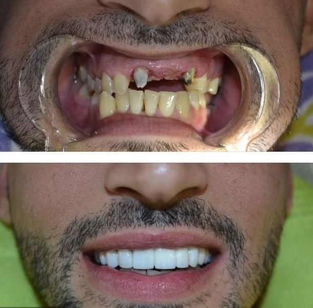 Иранският емигрант Сам Асгари бил дебел и с ужасни зъби (Вижте как изглеждал преди да срещне Бритни Спиърс – Снимки) - Снимка 4